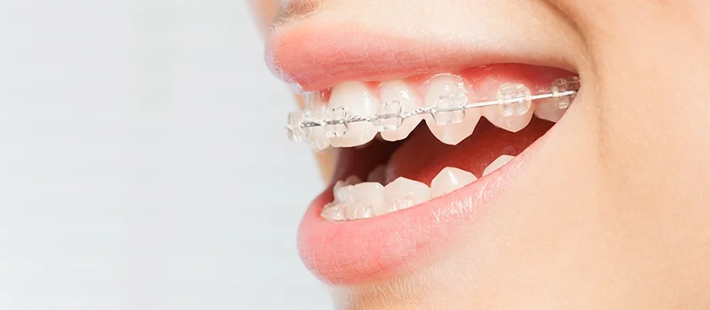 Brackets céramiques